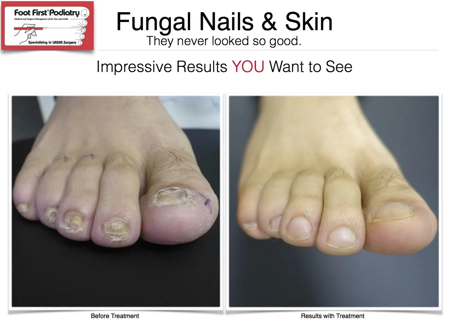 Popular Winter Procedures for your Feet! — Foot First Podiatry Centers